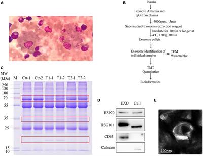 Plasma Exosomal Proteomic Pattern of Epstein-Barr Virus-Associated Hemophagocytic Lymphohistiocytosis